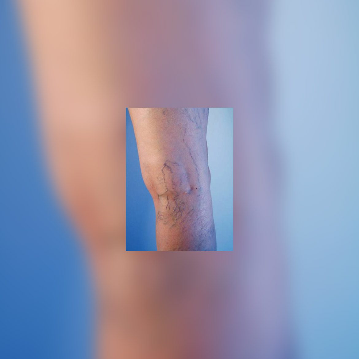 studio medico eur - La terapia sclerosante