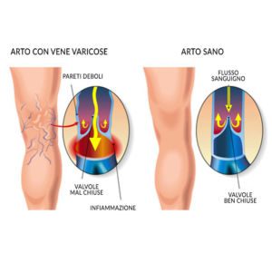 insufficienza venosa cronica - angiologo a roma