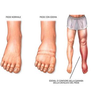 linfedema - angiologo a roma