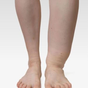 Gambe Gonfie - Angiologo Rroma