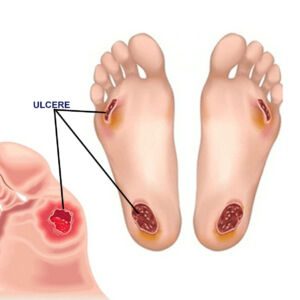 piede diabetico