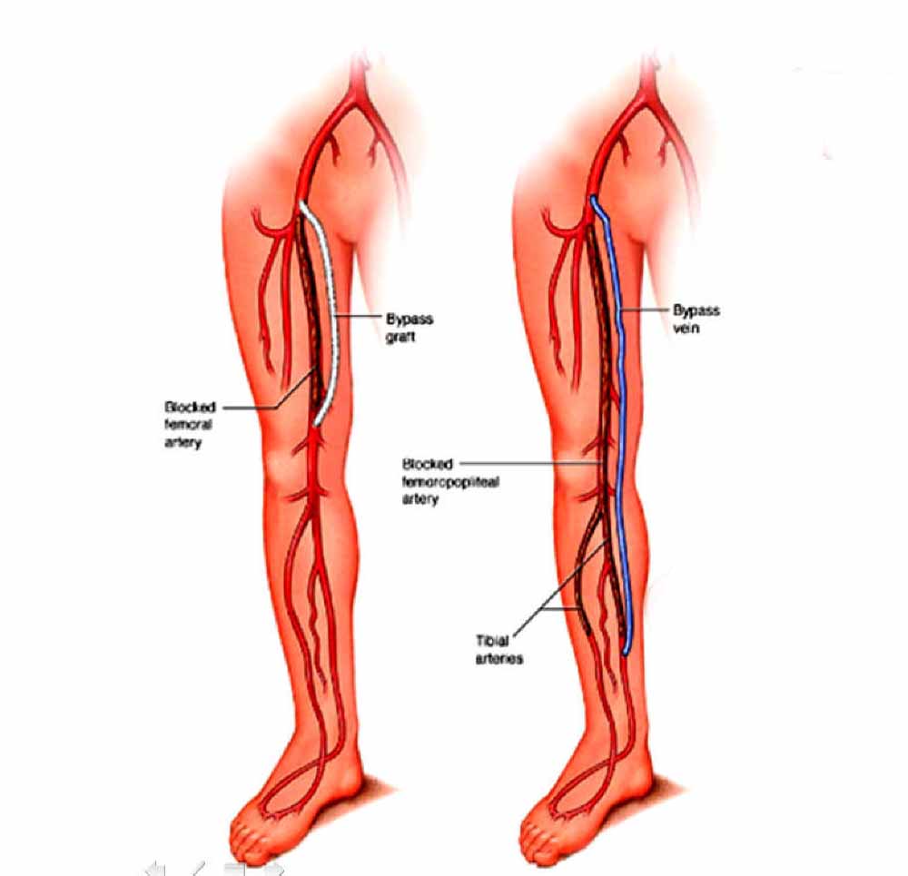 Arteriopatia ostruttiva degli arti inferiori